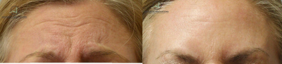 Botox before and after photo