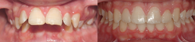 Braces before and after photo