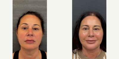 Eyelid Surgery before and after photo