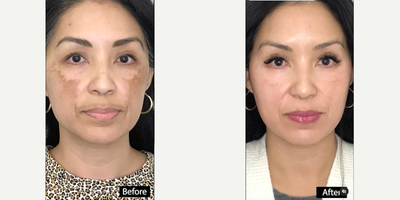 Laser Resurfacing before and after photo