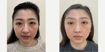 Morpheus8 before and after photo