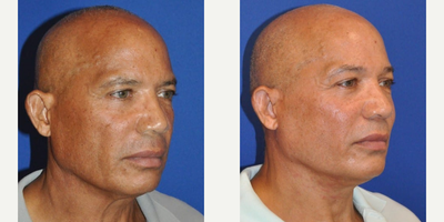 Neck Lift before and after photo