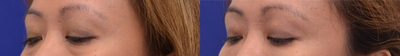 Restylane before and after photo