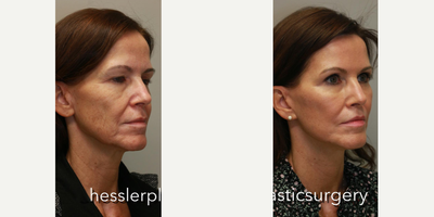Brow Lift before and after photo