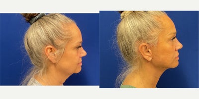 before and after image