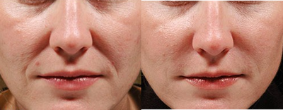 Juvederm before and after photo