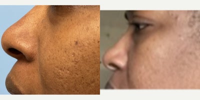 African American Rhinoplasty before and after photo