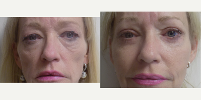 Eyelid Surgery before and after photo