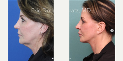Facelift Revision before and after photo