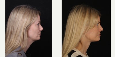 Facial Fat Transfer before and after photo