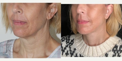 before and after image