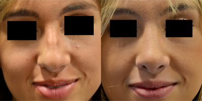 Rhinoplasty before and after photo