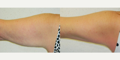 Arm Lift before and after photo