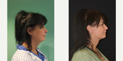 Eyelid Surgery before and after photo
