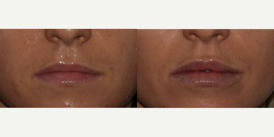 Lip Fillers before and after photo