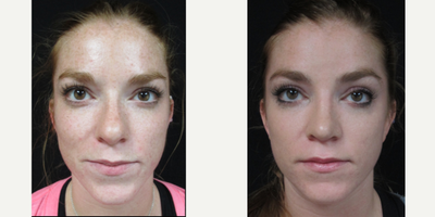 Rhinoplasty before and after photo