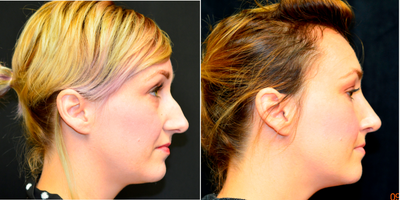 Rhinoplasty before and after photo