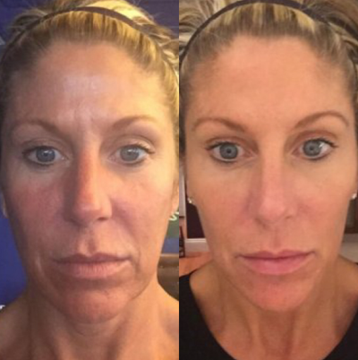 Botox before and after photo