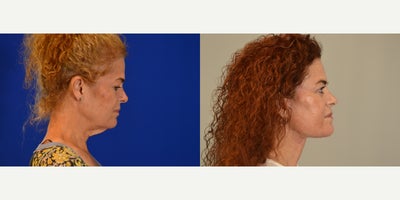 CO2 Laser before and after photo