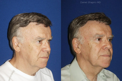 Eyelid Surgery before and after photo