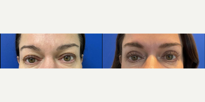 Eyelid Surgery before and after photo