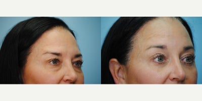 Eyelid Surgery before and after photo