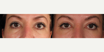 Restylane before and after photo