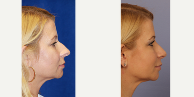 Rhinoplasty before and after photo