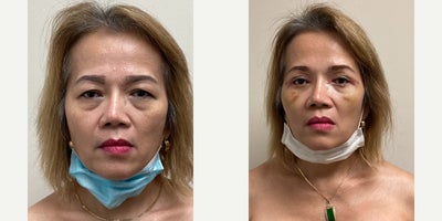 Skin Rejuvenation before and after photo