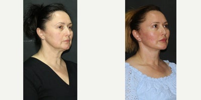 Facelift before and after photo