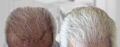Hair Transplant before and after photo