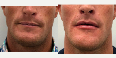 Juvederm before and after photo