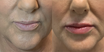 Lip Fillers before and after photo