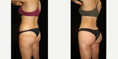 Liposuction before and after photo