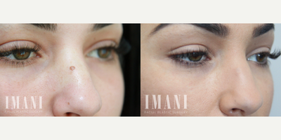 Mole Removal before and after photo