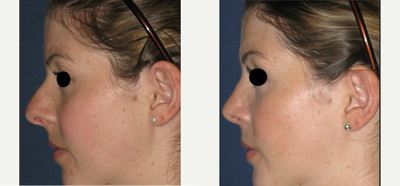 Rhinoplasty before and after photo