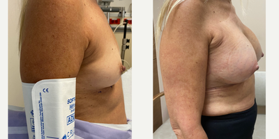 Breast Augmentation before and after photo