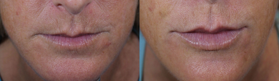 Dermal Fillers before and after photo