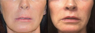 Lip Lift before and after photo