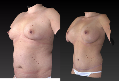 Mommy Makeover before and after photo