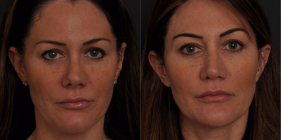 Revision Rhinoplasty before and after photo