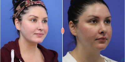 Revision Rhinoplasty before and after photo