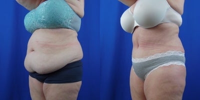 Tummy Tuck before and after photo