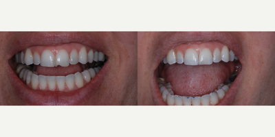 Dental Bonding before and after photo