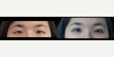 Double Eyelid Surgery before and after photo