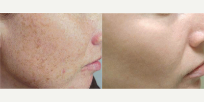 IPL before and after photo