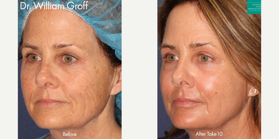 Laser Resurfacing before and after photo