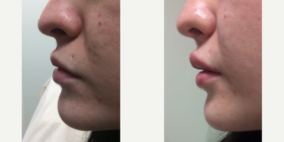 Restylane before and after photo