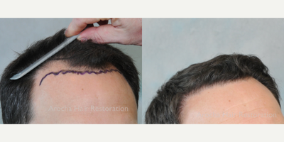 Hair Transplant before and after photo
