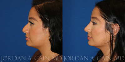 Nonsurgical Nose Job before and after photo